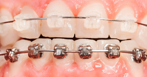 Orthodontic Treatment Planning Customized Approaches for Every Patient